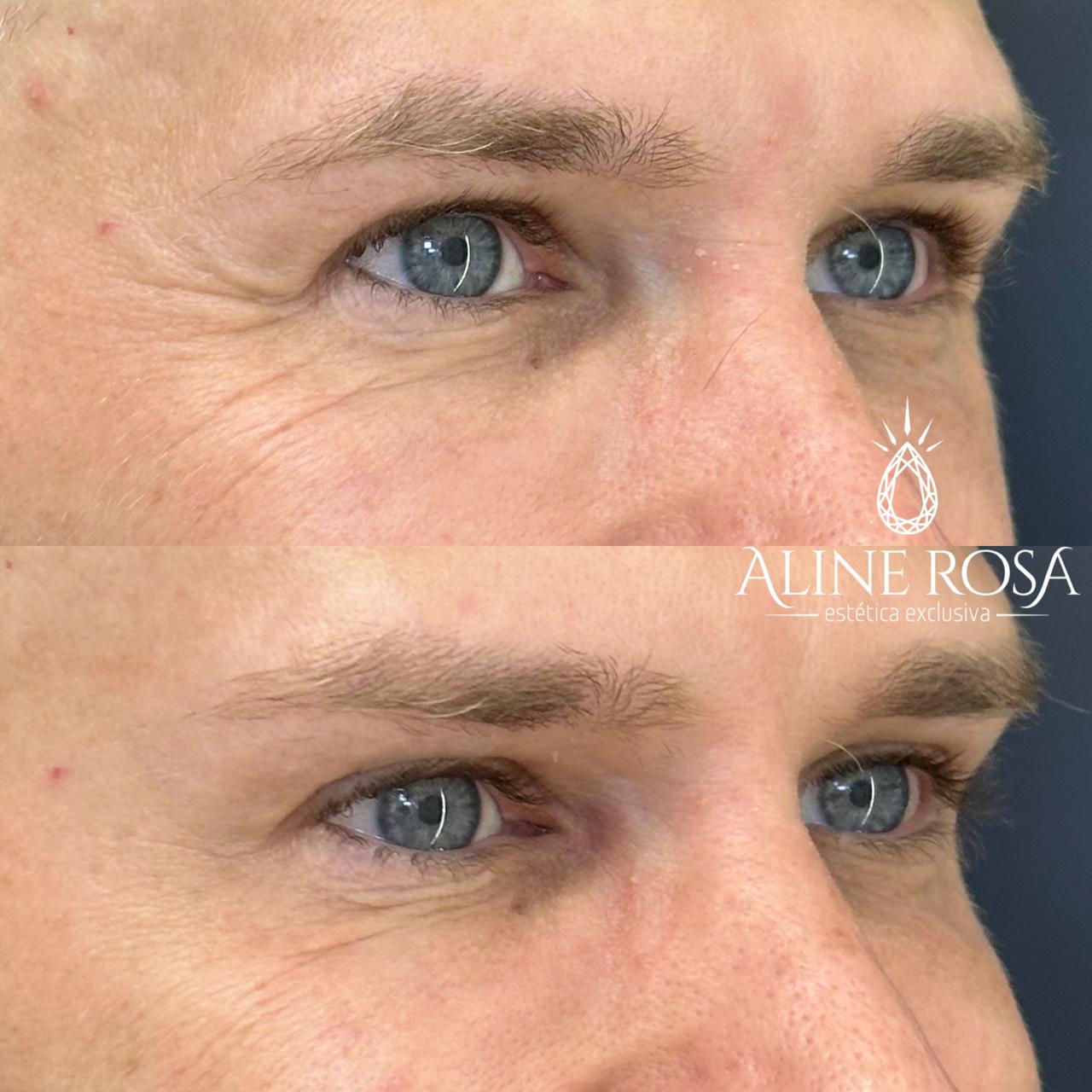 Botox Terço Superior Masculino